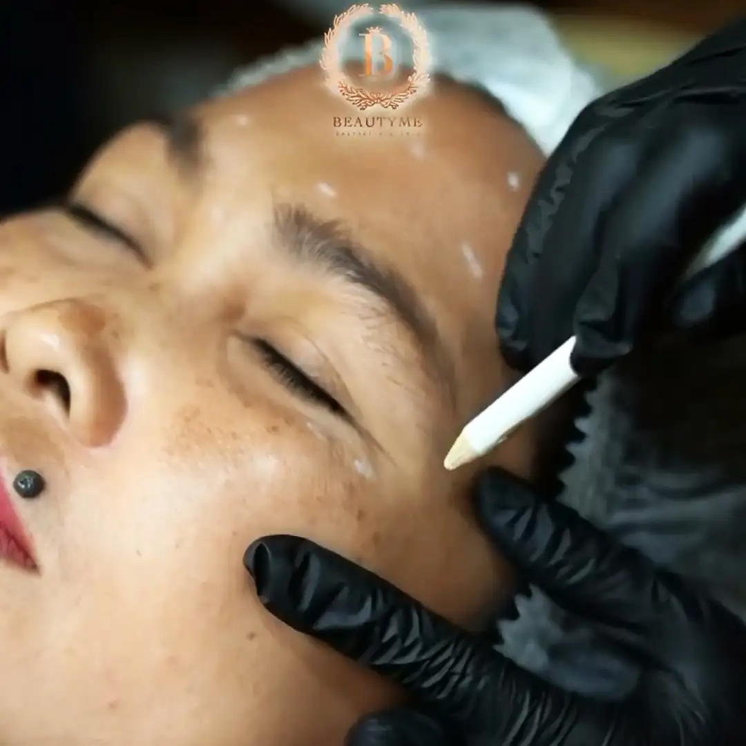 Kerutan Halus di Dahi Dan Filler Hidung